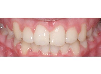 After - Bright Orthodontics