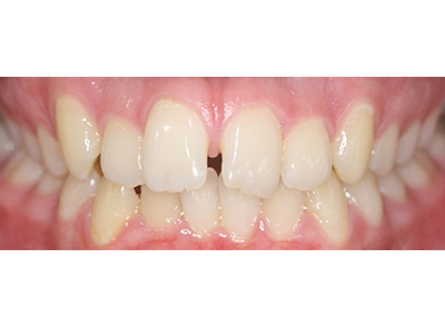 Before - Bright Oorthodontics