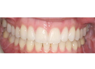 After - Bright Orthodontics