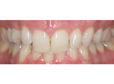 Before - Bright Oorthodontics