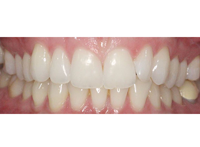 Before - Bright Oorthodontics