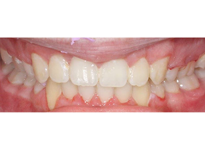 After - Bright Orthodontics