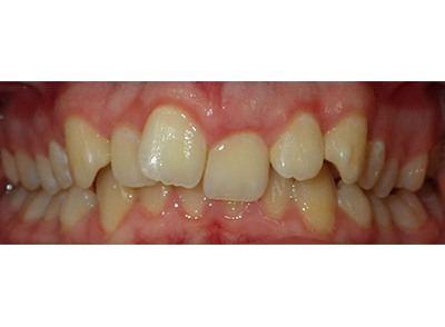 Before - Bright Oorthodontics